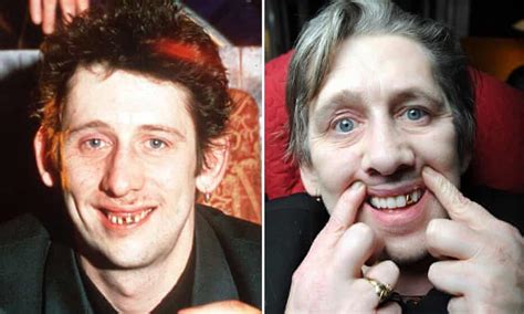 shane macgowan teeth before and after